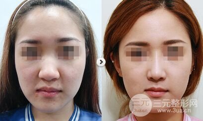 鼻翼过大如何变小、缩小鼻翼方法有哪些