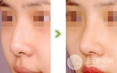 驼峰鼻矫正术后果怎么样，自然吗