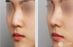 驼峰鼻矫正术后如何护理，有哪些注意事项