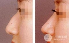 做驼峰鼻矫正手术好吗，能改良鼻形吗