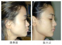 注射隆鼻后注意事项有哪些、如何护理