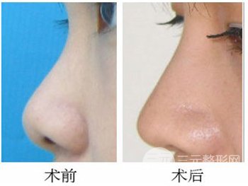 注射玻尿酸隆鼻后能看出痕迹吗