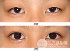 埋线双眼皮果通常可以管多少年