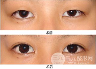 埋线双眼皮果通常可以管多少年
