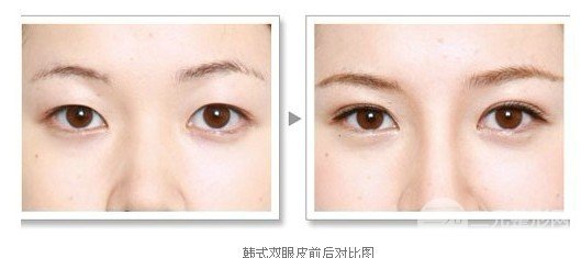 埋线双眼皮多久能恢复，可以保持几年