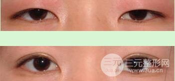 切开双眼皮和埋线有什么区别，哪个比较好