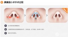 怎样使鼻子变小 鼻翼缩小手术的果明X吗