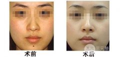 光子嫩肤可以美白淡斑吗？果怎么样？