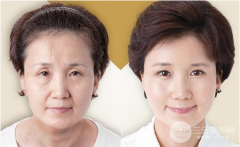 电波l皮除皱果展示真实案例