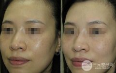 光子嫩肤果怎么样？可以祛斑美白吗？