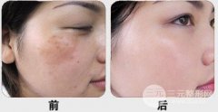 E光嫩肤可以美白祛斑吗?果可以保持多久? E光嫩肤可以美白祛斑吗?果可以保持多久?