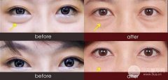 超声吸脂祛眼袋后多久可以洗脸？恢复时间是多久？