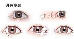 做开眼角手术多久恢复？应该注意什么问题？