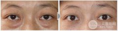 眼部超声吸脂手术果以及注意事项