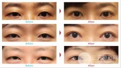 上眼皮松弛怎么办？上眼睑下垂矫正方法大全