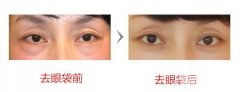眼袋很严重怎么办？祛眼袋果喜欢的手术