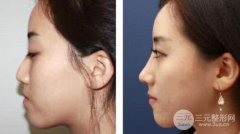 注射隆鼻整形术果能持续多长?术后如何护理?