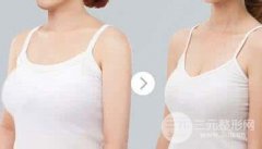 胸部整形巨大乳房缩小术术前注意和术后护理有哪些?