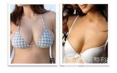 胸部整形巨大乳房缩小之后会再变大吗?