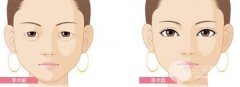 眼部整形去眼袋之后眼袋又会出现吗?