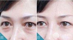 射频溶脂去眼袋有哪些优势?