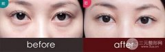 超声波法去除眼袋的优缺点有哪些?手术果好不好?