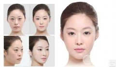 激光去眼袋有哪些优点?术后如何护理?