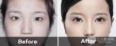 双眼皮手术与传统双眼皮手术相比谁好?手术方式有哪些?