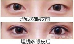 眼部整形埋线双眼皮失败怎样进行修复?禁忌人群有哪些？