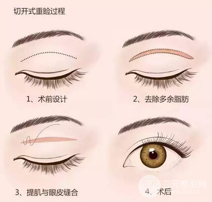 做双眼皮是埋线好还是切开好？