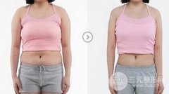 女性月经期间可以做吸脂减肥手术吗