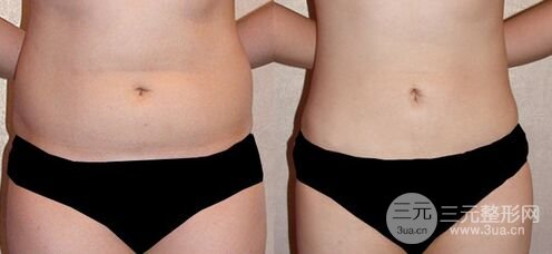 腰腹吸脂后影响怀孕吗、有坏处吗