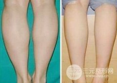 水动力吸脂瘦小腿果如何、会反弹吗