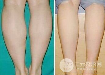 水动力吸脂瘦小腿果如何、会反弹吗