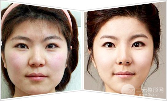 面部吸脂瘦脸好吗、果怎么样
