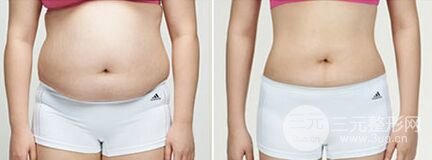 腰腹吸脂手术有哪些优点、好处是什么