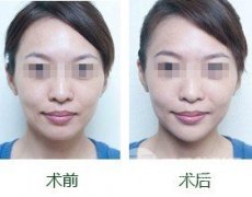 假体隆下巴失败后可以取出吗