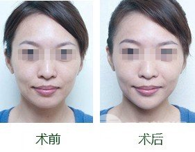 假体隆下巴失败后可以取出吗