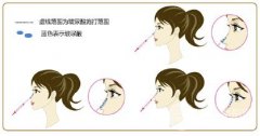 注射隆鼻怎么样,多少钱 注射隆鼻怎么样,多少钱