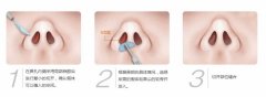 鼻头整形怎么样,果好不好 鼻头整形怎么样,果好不好