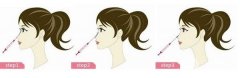 注射隆鼻果能维持多久，有后遗症较轻（不代表不会出现后遗症）