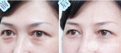 去眼袋的方法哪种果比较好