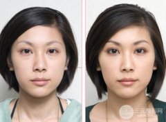吸脂释放眼袋修复的方法怎么样