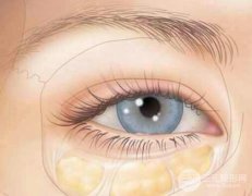 眼袋与卧蚕有哪些区别