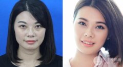 祛眼袋方法大全 年龄不同方法不同