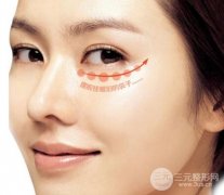 祛眼袋整形方法有几种