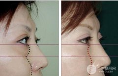 怎样选择合适自己的祛眼袋方法