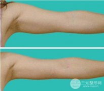 粗壮的手臂吸脂减肥过程
