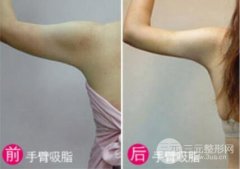 手臂做吸脂减肥哪里好
