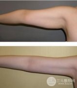 手臂吸脂手术后多久可以做运动